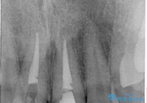 保険治療後の見た目が気になる方へ|セラミッククラウンで美しく自然な仕上がりにの治療前
