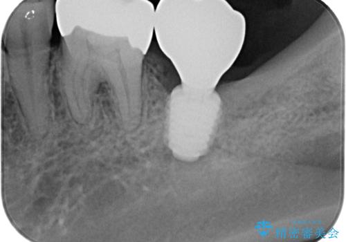 抜歯即時インプラントで治療期間を大幅短縮!抜歯からセラミックまでを3か月で完了
