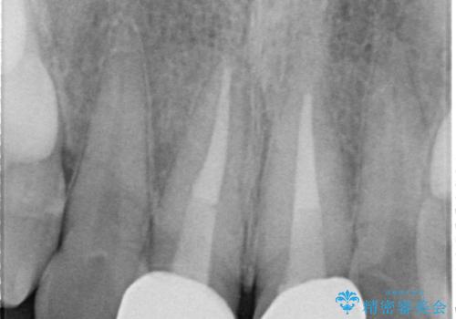 保険治療後の見た目が気になる方へ|セラミッククラウンで美しく自然な仕上がりにの治療後