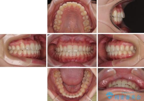 マウスピース矯正が煩わしい ワイヤー装置での非抜歯矯正の治療後