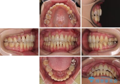 急速拡大装置 狭い骨幅を拡大した上で、顕著なデコボコを改善する抜歯矯正治療の治療後