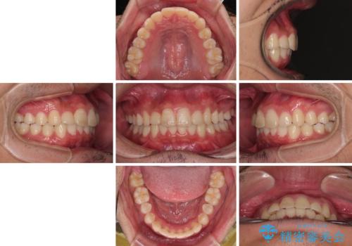 デコボコをインビザライン矯正で改善 奥歯は補助装置で確実に移動をの治療後