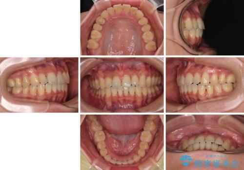 急速拡大装置 狭い歯列を拡大してクロスバイトを短期間矯正治療の治療後