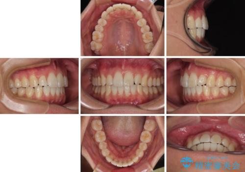 前歯のデコボコをインビザラインで綺麗に改善の治療後