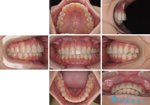 デコボコの非抜歯矯正 ワイヤー装置で楽して改善の治療後