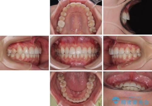 捻転の強い前歯 ワイヤー装置での非抜歯矯正の治療後