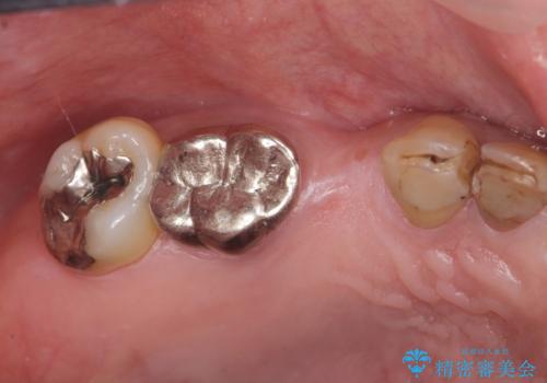 長期的な予後を見据えたインプラント治療の治療前