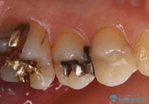 銀歯を白くしたい セラミックインレーの治療前