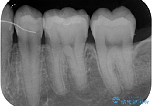 セラミックに取り替えたい　セラミックインレー修復の治療後
