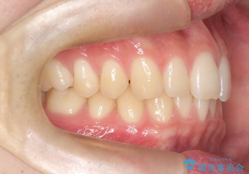 【ワイヤー矯正】すきっ歯を治したいの治療前