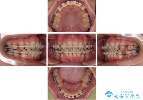 【モニター】前歯のデコボコと口元の出っ張りを改善!目立たない矯正で自然な笑顔にの治療中