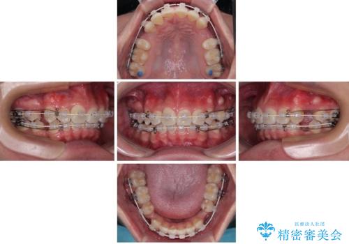 前歯のデコボコと正中のずれを改善!白い装置で目立たない矯正の治療中