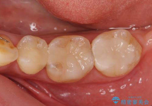 銀歯の下で虫歯の再発 拡大鏡下で行う虫歯の精密治療の症例 治療後