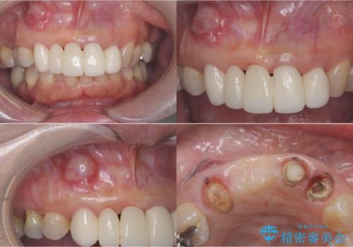 歯茎の腫れが気になる方必見!|抜歯即時インプラントで前歯5本を痛みなく3か月で治療完了!の治療中
