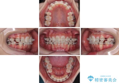 斜め前に飛び出した前歯 抜歯矯正で素敵な横顔にの治療中
