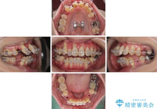 急速拡大装置 狭い骨幅を拡大した上で、顕著なデコボコを改善する抜歯矯正治療の治療中