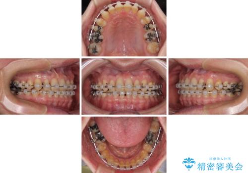 【モニター】ディープバイトで隙間の空いた歯列 ワイヤー装置での非抜歯矯正の治療中