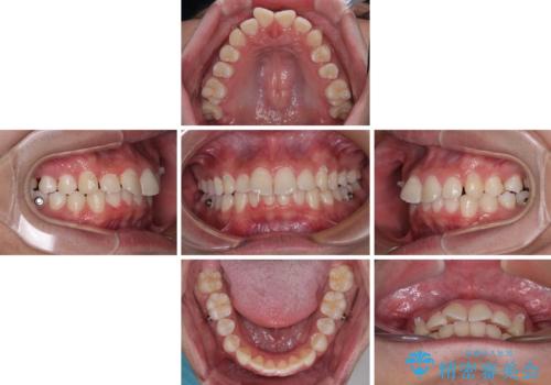 デコボコをインビザライン矯正で改善 奥歯は補助装置で確実に移動をの治療中