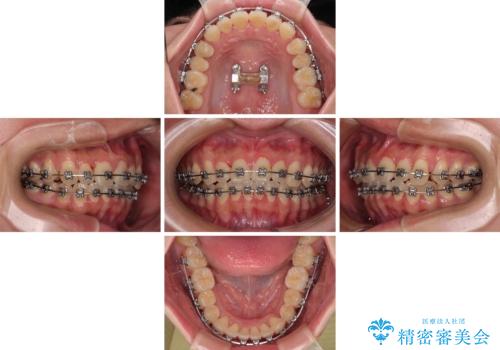 急速拡大装置 狭い歯列を拡大してクロスバイトを短期間矯正治療の治療中