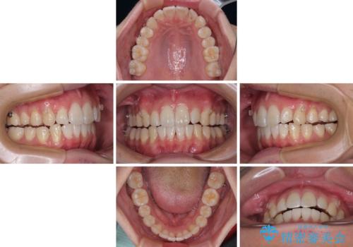 前歯のデコボコをインビザラインで綺麗に改善の治療中