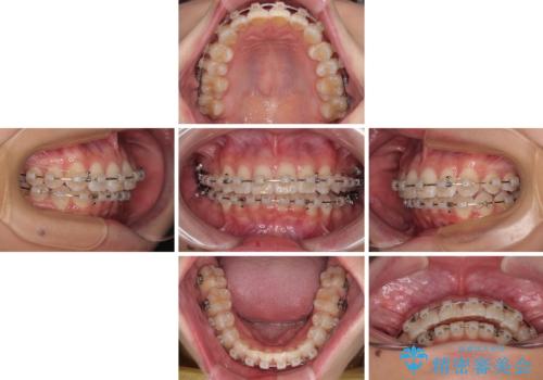 デコボコの非抜歯矯正 ワイヤー装置で楽して改善の治療中