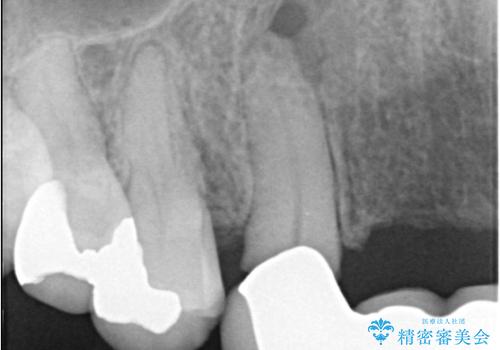 歯茎の腫れが気になる方必見!|抜歯即時インプラントで前歯5本を痛みなく3か月で治療完了!の治療前