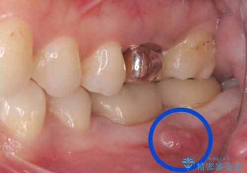 【歯牙移植】奥歯抜歯と言われたので親知らずを移植してほしいの治療前