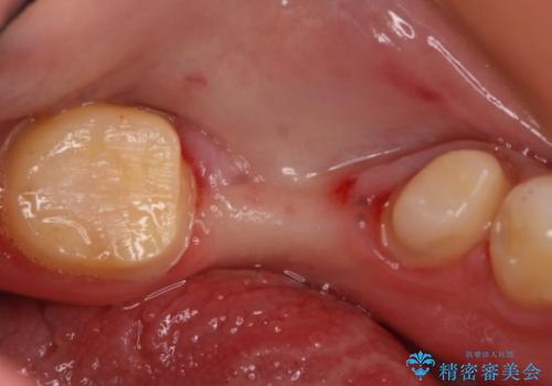 銀歯をやり変えたい フルジルコニアブリッジの治療中