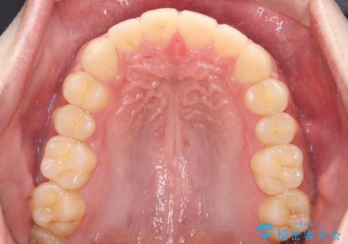 【ワイヤー矯正】すきっ歯を治したいの治療後