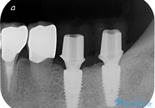 [ 不適合な補綴物による虫歯の再発 ]  劣化の進んだブリッジの再治療の治療中
