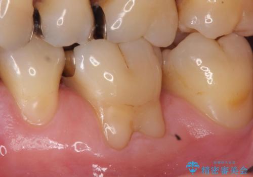歯肉退縮に対する結合組織移植の症例 治療前