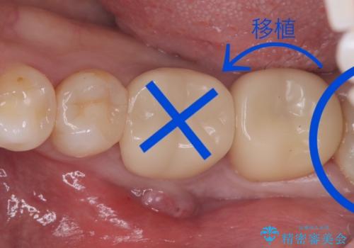 【歯牙移植】奥歯抜歯と言われたので親知らずを移植してほしいの治療前