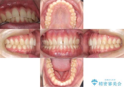 【ワイヤー矯正】すきっ歯を治したいの症例 治療前