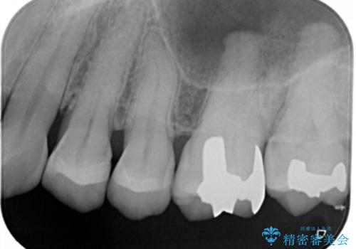 銀歯を白くしたい セラミックインレーの治療後