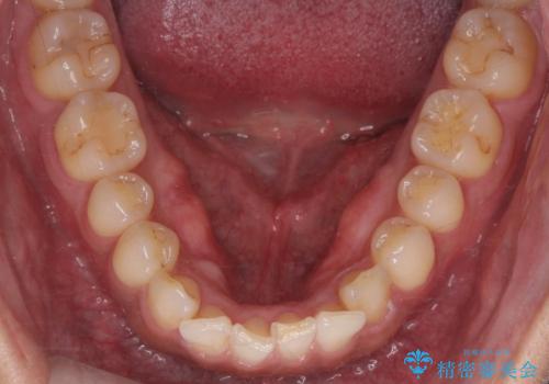 骨隆起を取りたいの症例 治療前
