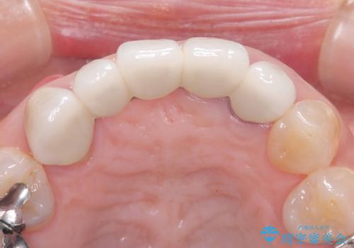 歯茎の腫れが気になる方必見!|抜歯即時インプラントで前歯5本を痛みなく3か月で治療完了!の治療前