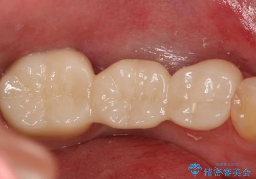 銀歯をやり変えたい フルジルコニアブリッジ