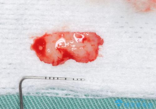 骨隆起を取りたいの治療後