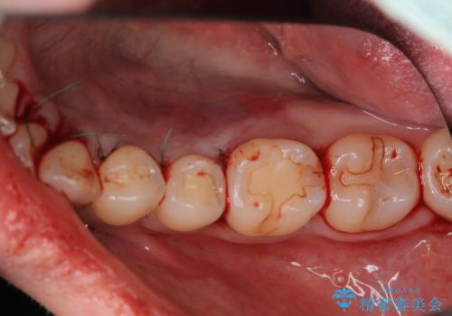 骨隆起を取りたいの治療中