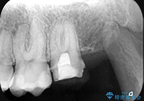 虫歯を治したい〈セラミック〉の治療中