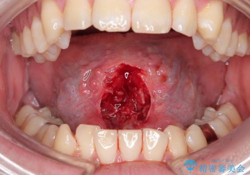 舌小帯を切りたい。の治療中