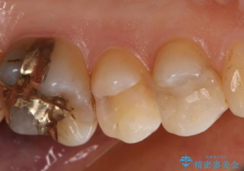 銀歯を白くしたい　セラミックインレーの治療中