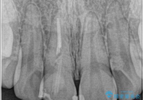 前歯が欠けた。の治療前