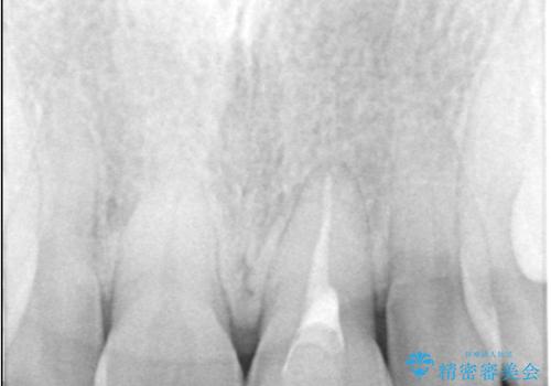 前歯の変色が気になる〈セラミッククラウン〉の治療前