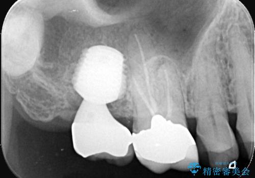 根尖性歯周炎|歯根嚢胞|インプラント治療の治療後