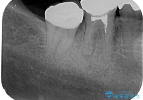 右下の銀歯が外れた オールセラミッククラウンの治療後