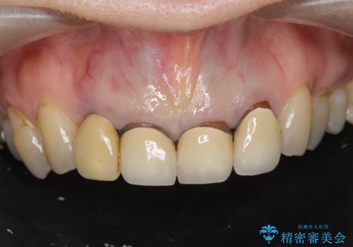 境目の見える前歯をきれいにしたい セラミック治療の症例 治療前