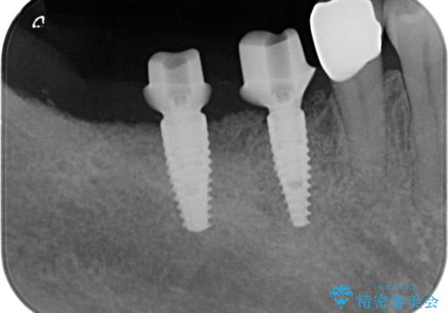 長期的な予後を見据えたインプラント治療の治療中