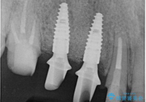 長期的な予後を見据えたインプラント治療の治療中