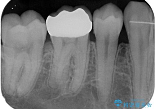 銀歯をセラミックにしたい オールセラミッククラウンの治療後